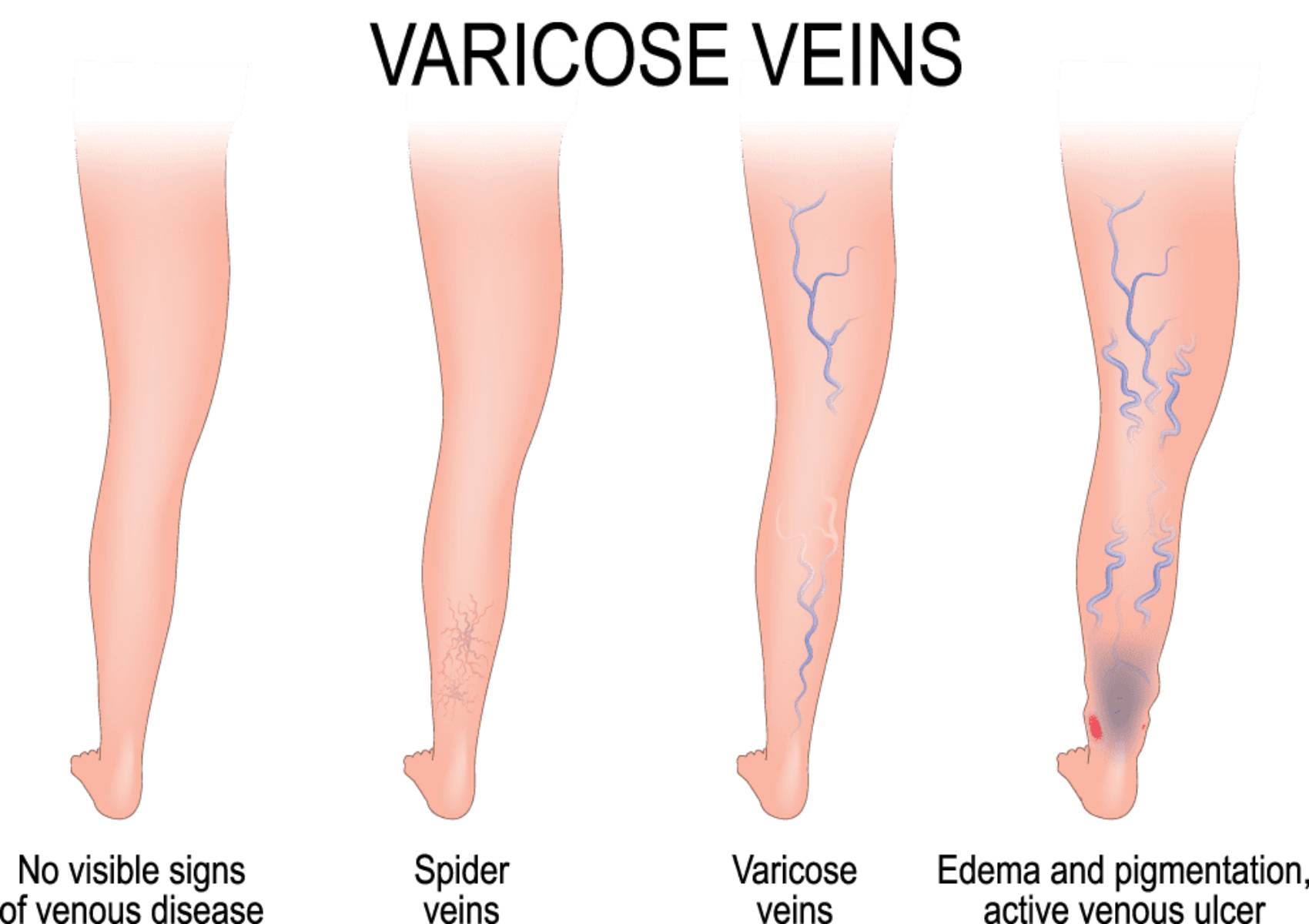 Leg Swelling Imaging And Interventional Specialists