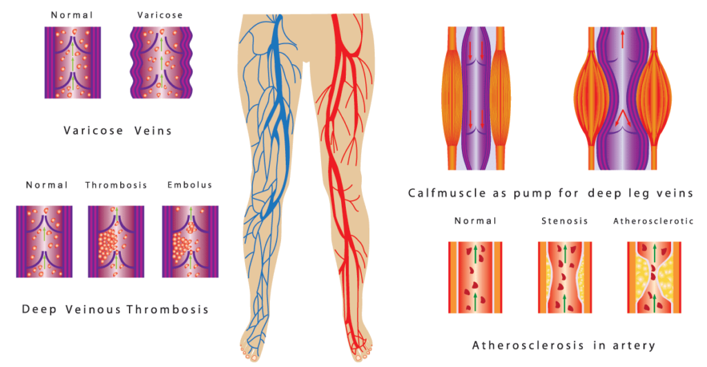 Enfermedad vascular periférica: ¿Qué es?