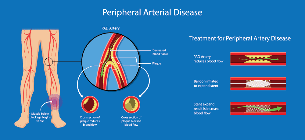 Enfermedad vascular periférica: ¿Qué es?