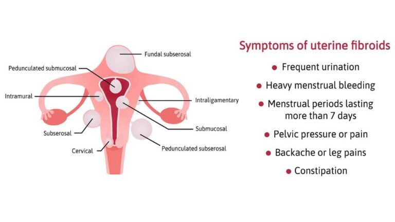 Uterine Fibroid - Imaging And Interventional