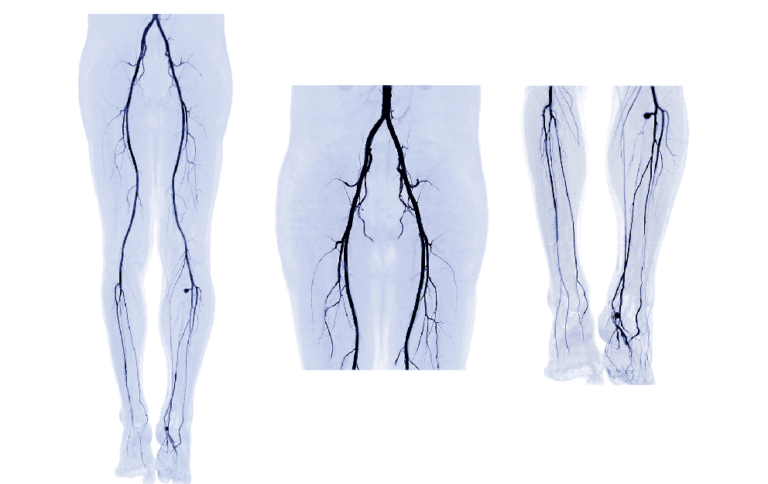 Angiography | Imaging And Interventional Specialists