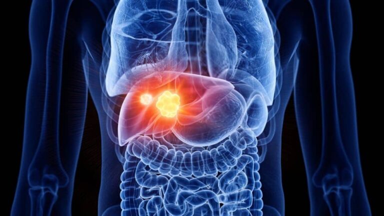 Liver Cancer - Imaging and Interventional