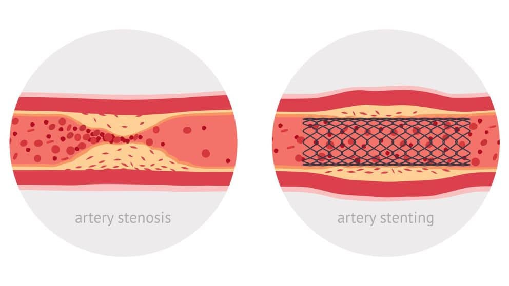 What is a Stenosis